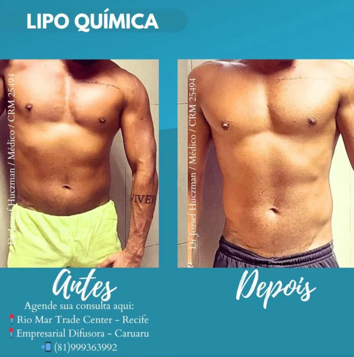 Resultados Lipo Química Antes e Depois