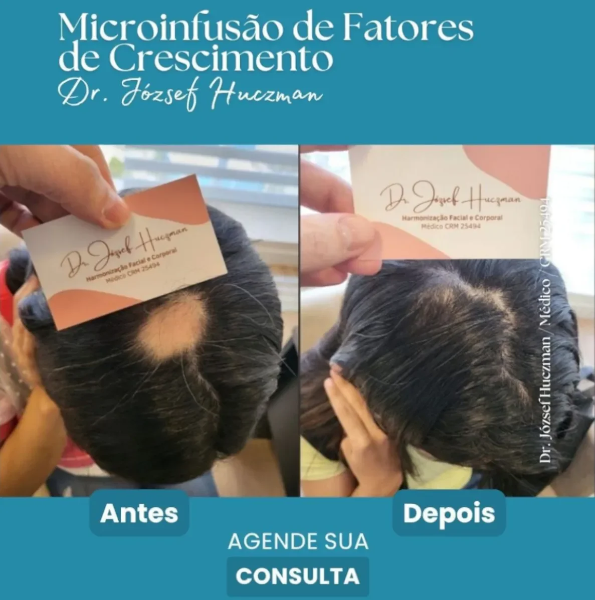 Microinfusão Capilar Feminina Resultados