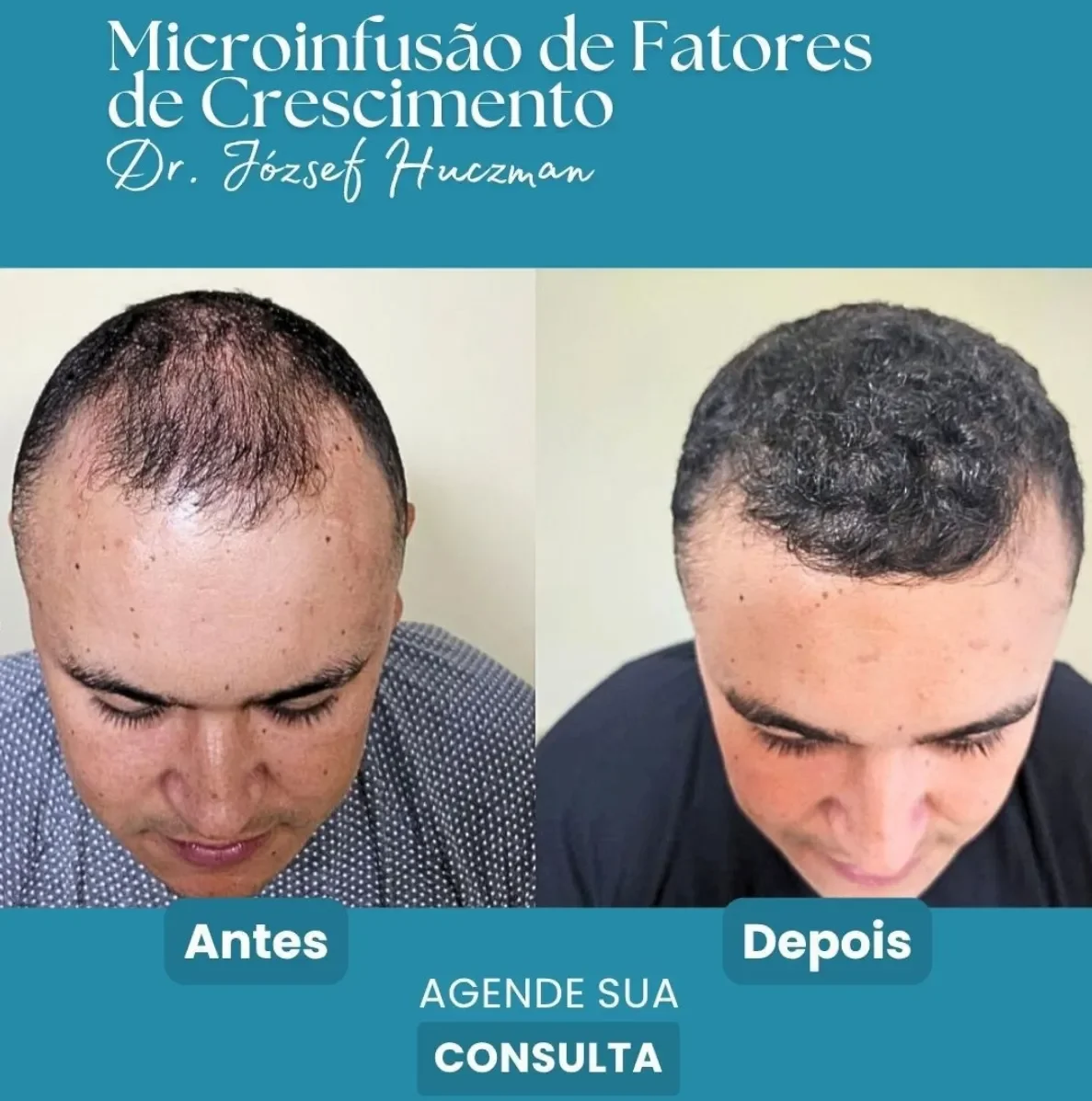 Microinfusão Capilar Masculina Resultados